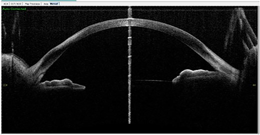 Two weeks later: Anterior segment OCT showed residual stromal scar in the stromal layer of the right eye.