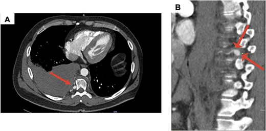 (A) Axial CT with contrast demonstrating a large right hemothorax on presentation; (B) sagittal CT with contrast, arrows showing T9 intercostal artery aneurysm.