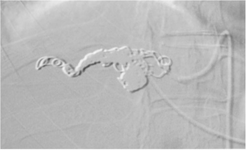 Angiography of T9 intercostal artery aneurysm with successful coil embolization of T9 intercostal artery aneurysm.