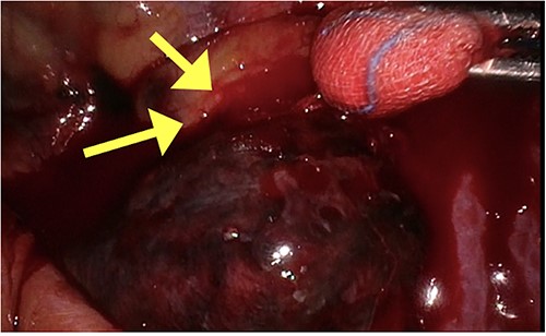 Intraoperative picture of aneurysm with friable tissue and bleeding vessel highlighted by arrows.