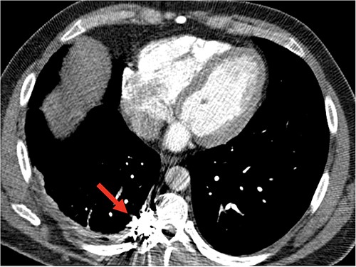 Follow-up CT angiogram demonstrated a persistent occlusion of aneurysm, noted by arrow, and resolution of the hemothorax.