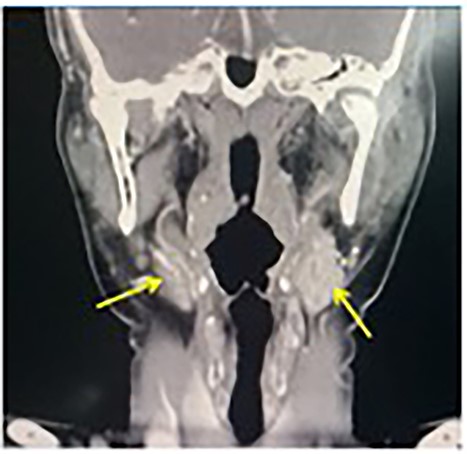 CECT neck (coronal view) view showing bilateral CBTs (arrows).