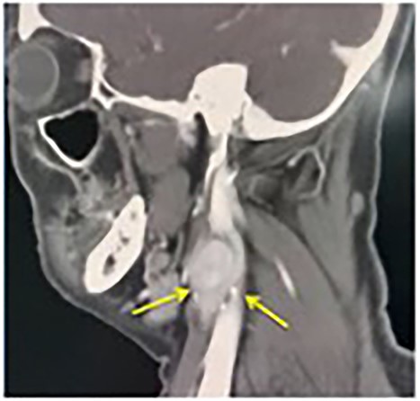 Lyre sign. Tumour in between ECA and ICA (arrows).