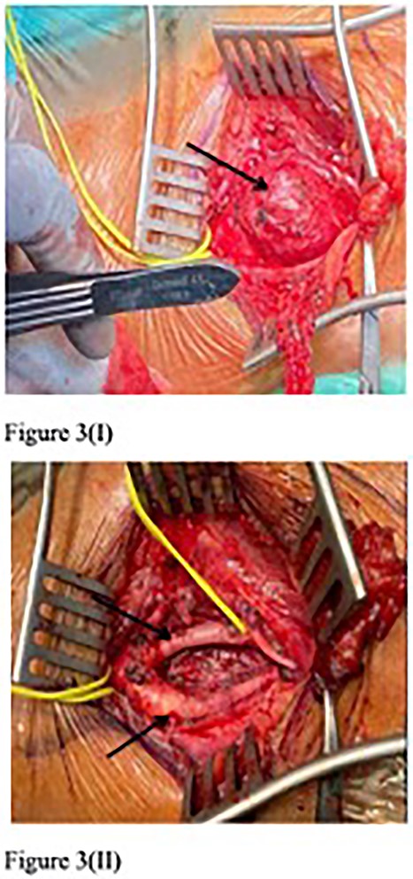 First surgery resection of left CBT (arrow) (I), with intact ECA and ICA post-operation (II).