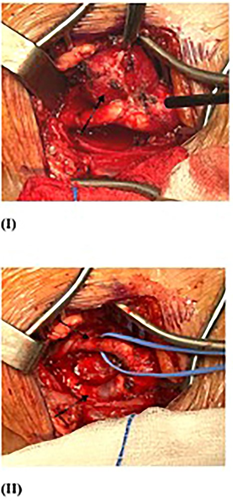 Second surgery resection of right CBT (arrow) (I), with intact ECA and ICA post-operation (II).
