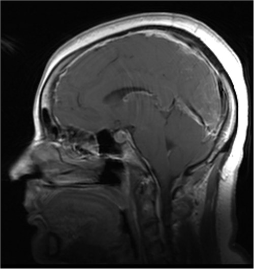 Illustrative sagittal gadolinium enhanced T1 MRI of the brain demonstrating the sequalae of intracranial hypotension, the likes of which may be precipitated by a ventral spinal dural defect; there is smooth pachymeningeal enhancement, partial effacement of the cortical sulci, sagging cerebellar tonsils, a full appearing pituitary gland and slight prominence of the straight sinus; illustrative sagittal gadolinium enhanced T1 MRI of the brain, demonstrating the sequalae of intracranial hypotension, the likes of which may be precipitated by a ventral spinal dural defect; case courtesy of Behrang Amini, from the case rID: 36019 (https://radiopaedia.org/cases/36019?lang=gb)