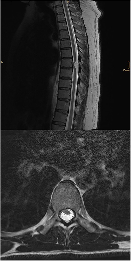 Illustrative sagittal and axial T2 MRI of the spine demonstrating ventral SCH; there is focal anterior displacement of the spinal cord out of the dural sac through a dural defect at the T7 level; unlike in the present case, these images demonstrate an ill-defined focus of T2 hyperintensity within the cord at the T7 level; case courtesy of Kamran Hajiyev, from the case rID: 76419 (https://radiopaedia.org/cases/76419?lang=gb)