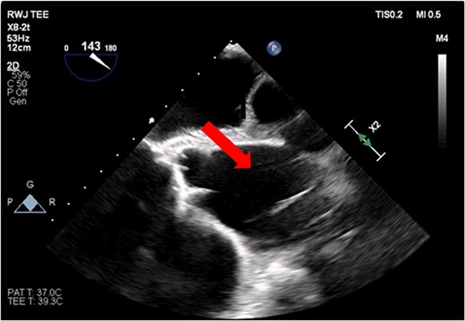 Transesophageal image of the aortic root and ascending aorta with IABP present.