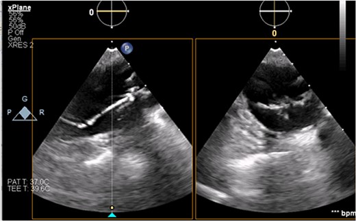 Transesophageal image of the ascending and descending aorta with mispositioned IABP present.