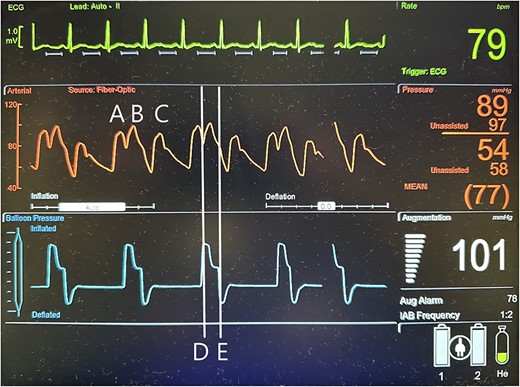 Illustration of a normal IABP arterial waveform with IABP augmentation of diastolic and systolic pressures and normal IABP pressure waveform corresponding to inflation and deflation of the device with a distinctive pressure plateau. A = unassisted heart beat arterial pressure waveform; B = IABP generated arterial pressure waveform; C = assisted heat beat arterial pressure waveform; D = IABP balloon inflation pressure waveform; E = IABP balloon deflation pressure waveform.