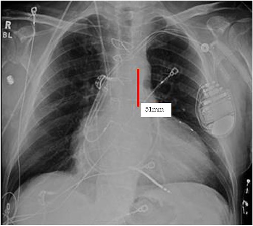 Initial CXR: note the proximal and distal radiopaque markers of the IABP are visualized a few centimeters (5.1 cm) from each other; the proximity of the two markers indicates that along the path of the IABP, it has folded over itself causing the two markers to be abnormally close, as the 8Fr. balloon is 258 mm long, thus the markers should be separated by that much.