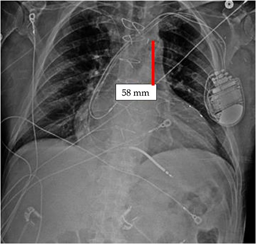 CXR done 21 days later, which shows the markers still not properly placed but the distance is about the same (5.8 centimeters) as the original position; additionally, the shadow of the inflated helium balloon can be seen in the ascending and aortic arch.
