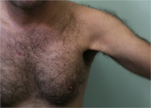 Patient practicing jiu jitsu with chronic rupture of the pectoralis major muscle tendon.