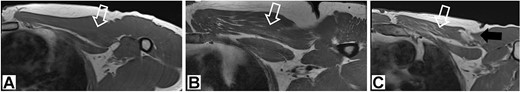 1.5 T T1 magnetic resonance image showing chronic aspects within the pectoralis major muscle.