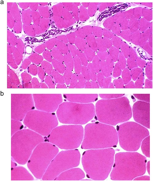 (a and b) Optical microscopy image showing haematoxylin eosin stained muscle from chronic cases of the pectoralis major muscle.
