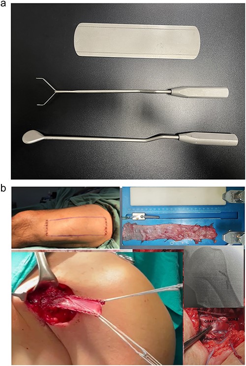Images of the surgical technique for extracting the fascia lata with an extraction device Larson ® (a) and reconstruction of the pectoralis major muscle tendon using a cortical button and autologous fascia lata graft (b).