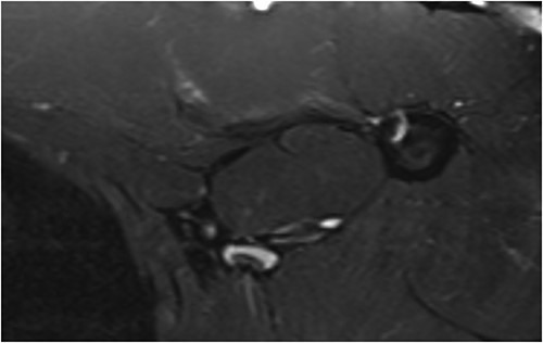 MRI of a patient 1 year post-operatively who underwent reconstruction surgery of the pectoralis major muscle tendon with fascia lata, showing a good image of tendon healing.