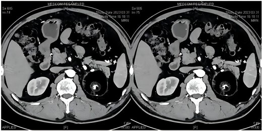 Adrenal gland CT: left adrenal gland huge tumor, size ~7.2*7.5 cm, internal fat mainly, see a “sac within a sac”, see calcification foci inside.