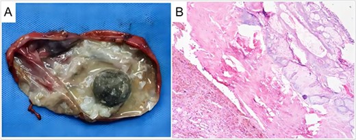 Macroscopic and microscopic picture of the tumor. (A) Tumor specimen. Calcification, hair, and lipid can be seen in the teratoma; (B) pathological examination (H&E staining). H&E, hematoxylin, and eosin.