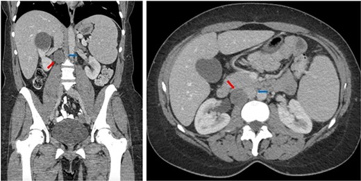 Coronal (left) and axial (right) CT of the abdomen and pelvis showing the retrocaval schwannoma (red arrow) and IVC (blue arrow).