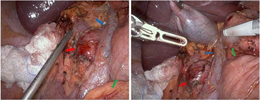 Intraoperative images showing the retrocaval schwannoma (red arrow), IVC (blue arrow), and duodenum (green arrow).