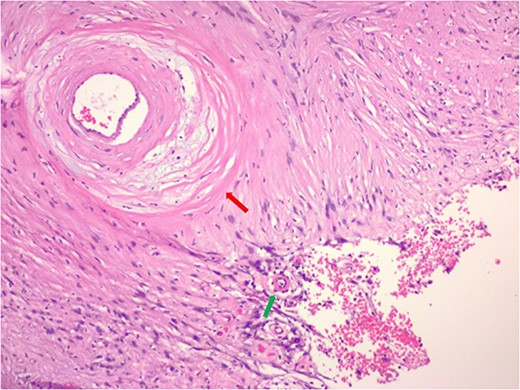 Hematoxylin and eosin stain pathologic slide of ancient schwannoma showing hyalinizing vessel (green arrow) and cystic degeneration (red arrow) characteristic of ancient changes.
