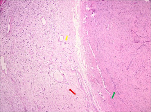 Hematoxylin and eosin stain pathologic slide of ancient schwannoma (green arrow) and adjacent ganglioneuroma (red arrow) with ganglion cell (yellow arrow).