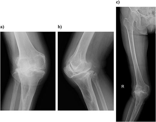 Plain radiography at the patient’s first visit: (a) standing front, (b) lateral side and (c) thigh, standing, front, full length. Valgus knee osteoarthritis and well-defined osteoporosis near the central part of the proximal tibia can be seen, and the rough surface of the tibia has been worn away.