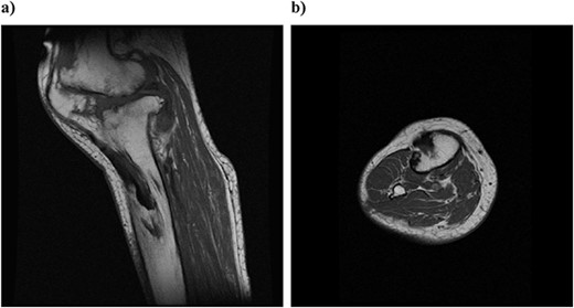 Preoperative simple magnetic resonance imaging: (a) lateral side and (b) axial morphism. T1- and T2-weighted images continuous from the patellar tendon attached to the patella both show continuity from the low signal area to the inside of the tibial bone marrow.