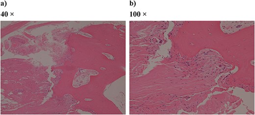 Pathologic specimen from surgery (hematoxylin–eosin staining): (a) 40 times and (b) 100 times. Bone tissue and fibrous tissue are both conspicuous, and ligament-like tissue is partially observed.