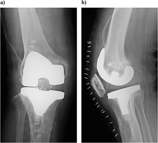Plain radiography immediately after the surgery: (a) front and (b) lateral side. A slight dilation of the medial joint space is observed.