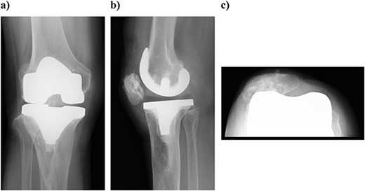 Outcome at 3 years after surgery on plain radiography: (a) standing front and (b) side. The patella is laterally subluxated in a slight valgus position.