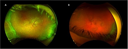 Right (A) and left (B) fundus examination illustrating hyperemic discs and circumferential choroidal detachments 1 week post initial presentation.