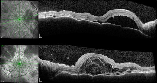 OCT 1 week after initial presentation illustrating neurosensory retinal and bacillary layer detachments, retinal pigment epithelium folds, and darkened choroid pathognomonic for VKH.