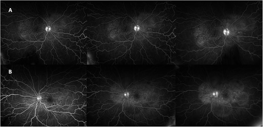 FFA demonstrating right (A) and left (B) disc hyperfluorecence and macular hyperfluorescent pinpoints, and pooling in areas corresponding to serous detachments.