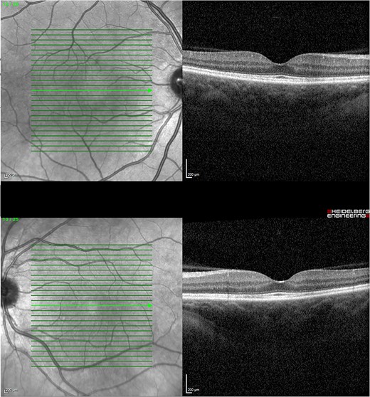 OCT 4 months post treatment showed complete resolution of fluid and reinstitution of normal retinal architecture.