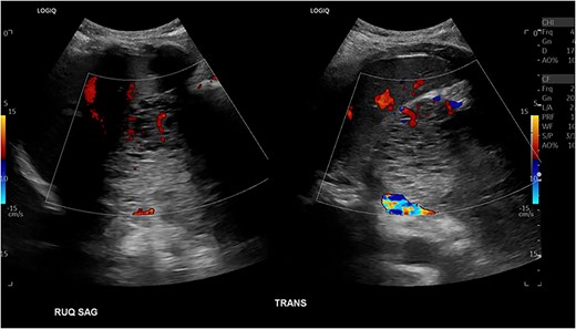 Abdominal US showing a nonspecific mass in RUQ with numerous microcysts.