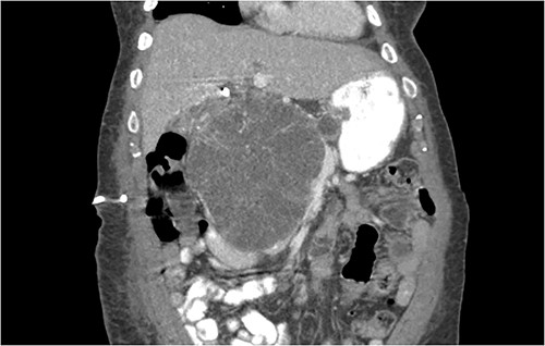 Coronal CT showing a large heterogeneous mass in the pancreatic head with typical honeycomb feature.