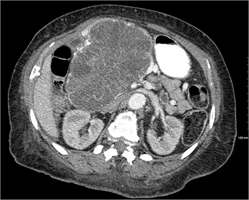 Mass effect to abdominal viscera from the 14 × 10 × 13 cm pancreatic head mass.