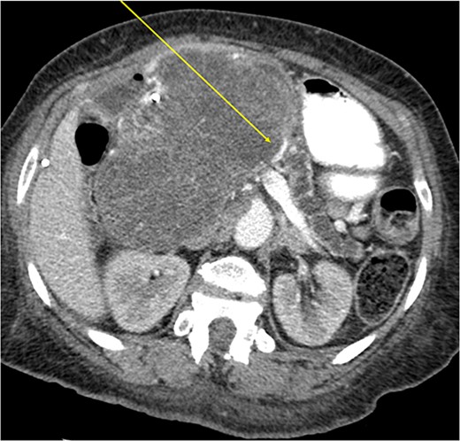 Effacement of SMV (arrow).
