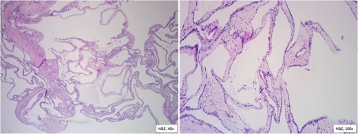 Histopathological features reveal the cysts lined by a single layer of cuboidal cells with clear, glycogen-rich cytoplasm, without atypia.