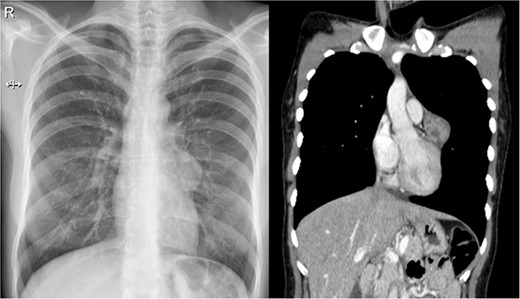 (a) Chest X-ray: a small rounded mass attached to the heart. (b) Chest CT shows a heterogeneous solid mass with well-defined borders close to the pericardium and near the trunk of the pulmonary artery.