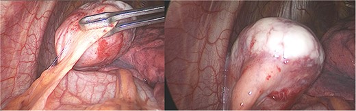 Laparoscopy, (a) hard white irregular tumor depends on the pericardium without invasion of the left phrenic nerve. (b) The tumor is adjacent to the lung but not invading it.
