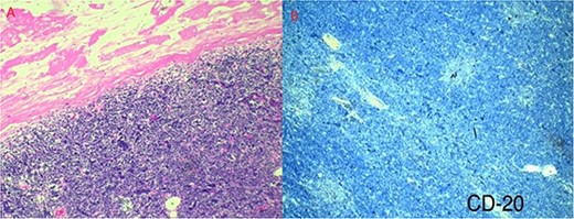 (a) Well-defined tumor formation, surrounded by a thickened fibrous connective capsule with focal areas of calcification and numerous small CD5-positive lymphocytes. (b) Immunohistochemistry shows a proliferative index of 30% with isolated positivity for CD20-positive B lymphocytes.