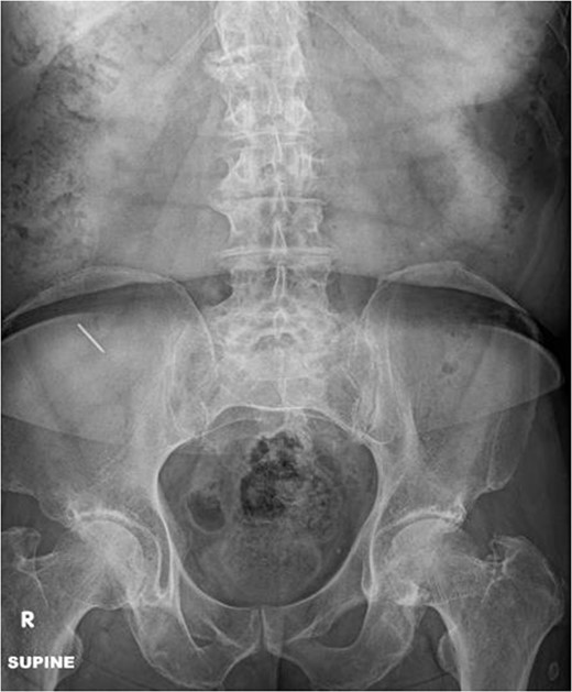 Abdominal radiograph shows a 2.3 cm linear radiopaque density in the right lower quadrant.