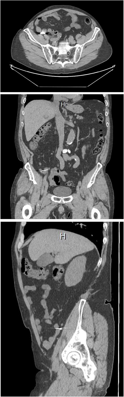 Computed tomography of the abdomen, axial, coronal, and sagittal views. The foreign body lies over the distal appendix. Detail is limited due to artifact.