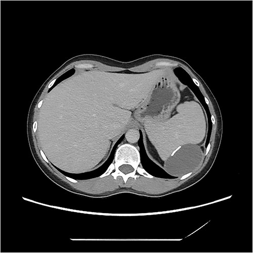 CT image demonstrating cyst adjacent to spleen and diaphgram with calcified walls.