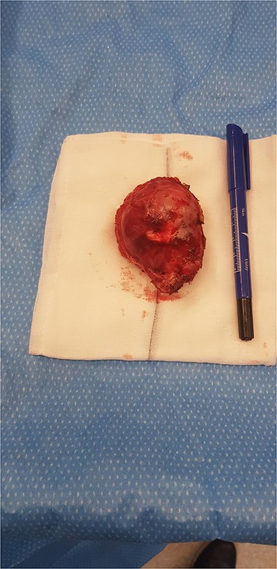 Surgical specimen – cyst excised with disc of diaphragm.