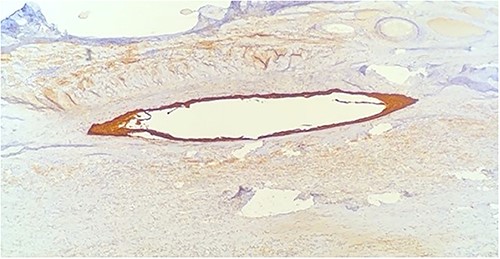 CK5 positive staining.