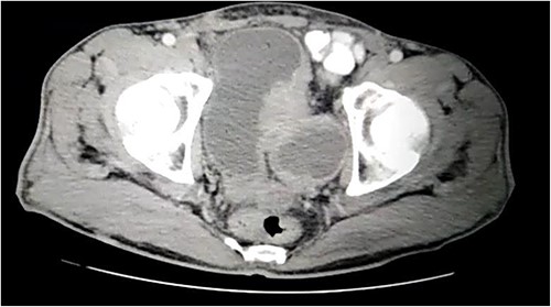 CT showing a large bladder diverticulum on the posterior wall with a mass within it.